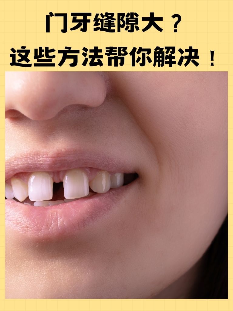 越来越大怎么办牙缝笑八岁小孩门牙牙缝很大怎么办门牙特别大的原因