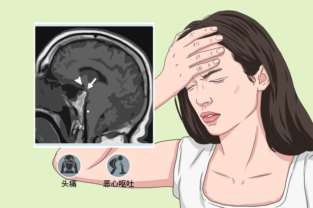 颅内低压性头痛:头痛背后的"隐形杀手"