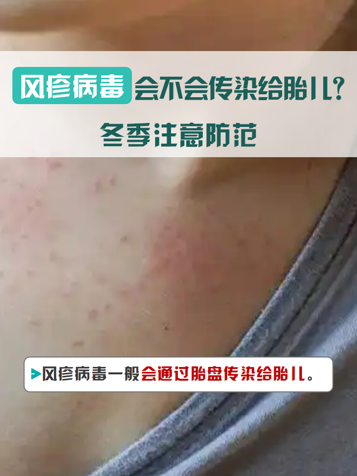 风疹病毒会不会传染给胎儿?