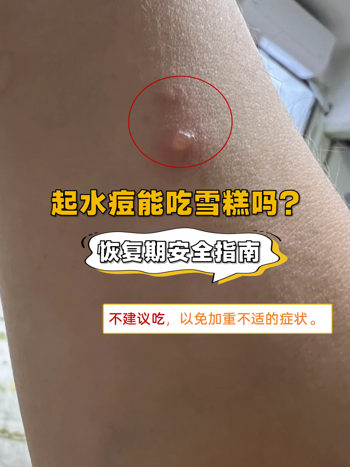 这是什么,会传染么起水痘水痘可以吃什么食物大人水痘可以挤破吗