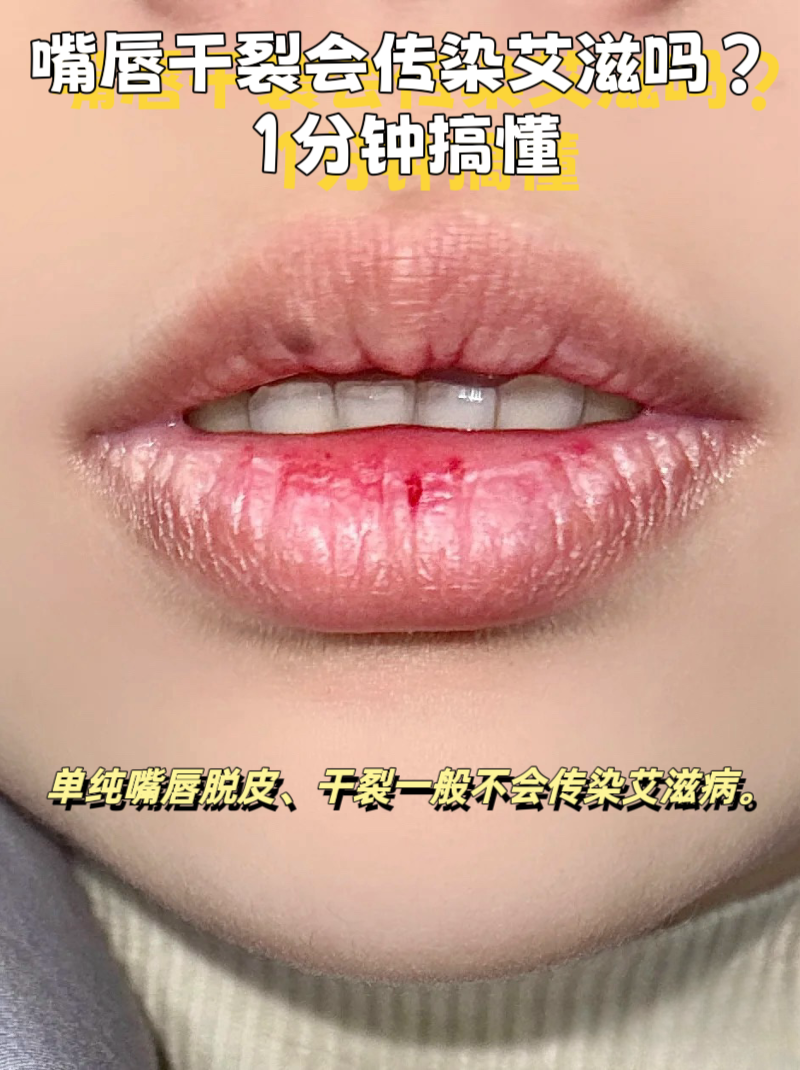 病初期症状 嘴唇艾滋病嘴唇有什么症状hiv嘴唇症状图片嘴唇干裂出血