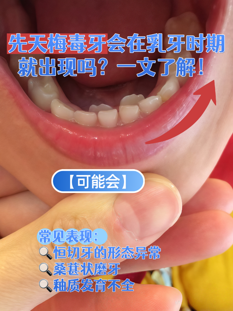 幼儿梅毒牙齿怎么治疗最好先天梅毒牙齿症状图片锯齿牙和梅毒牙的区别