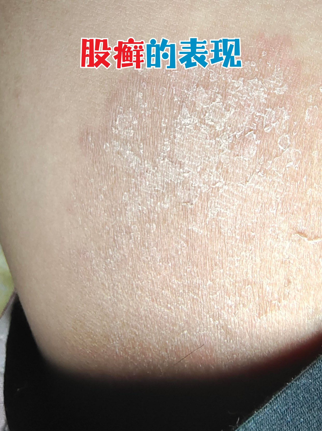 夏天出汗多,闷热潮湿的环境下,有些朋友发现大腿根部出现