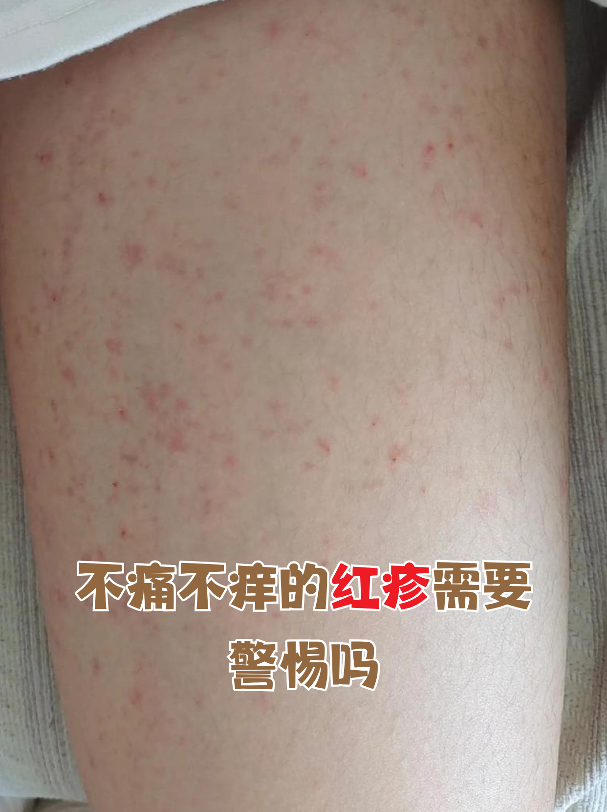 不痛不痒的红疹需要警惕吗