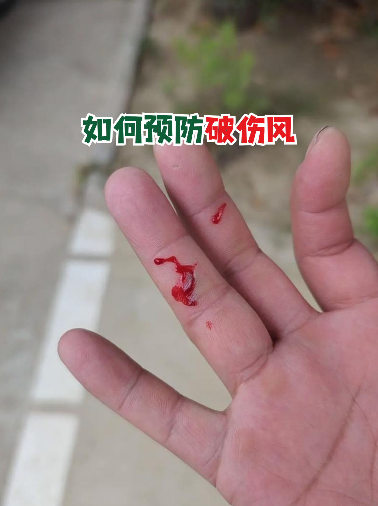 破伤风是一种由破伤风梭菌引起的严重感染,但通过