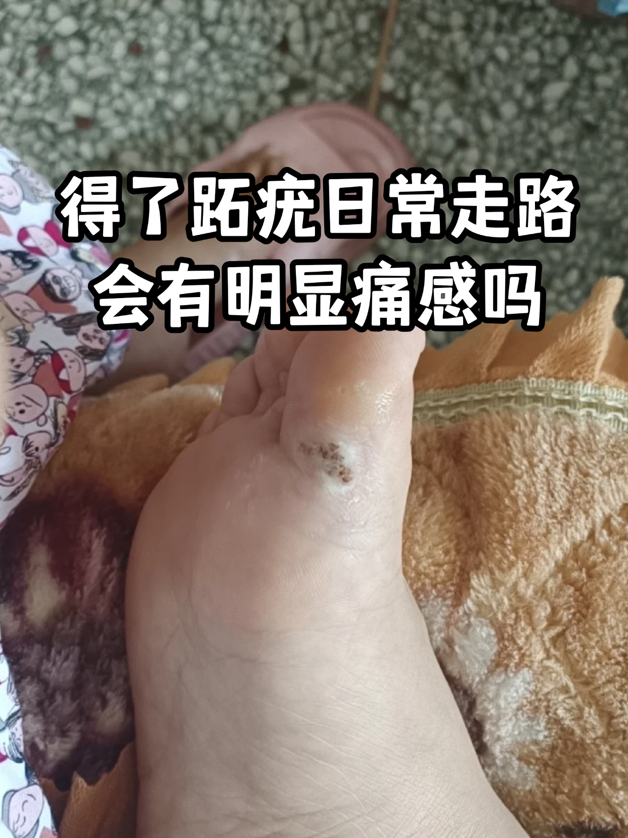 得了跖疣日常走路会有明显痛感吗