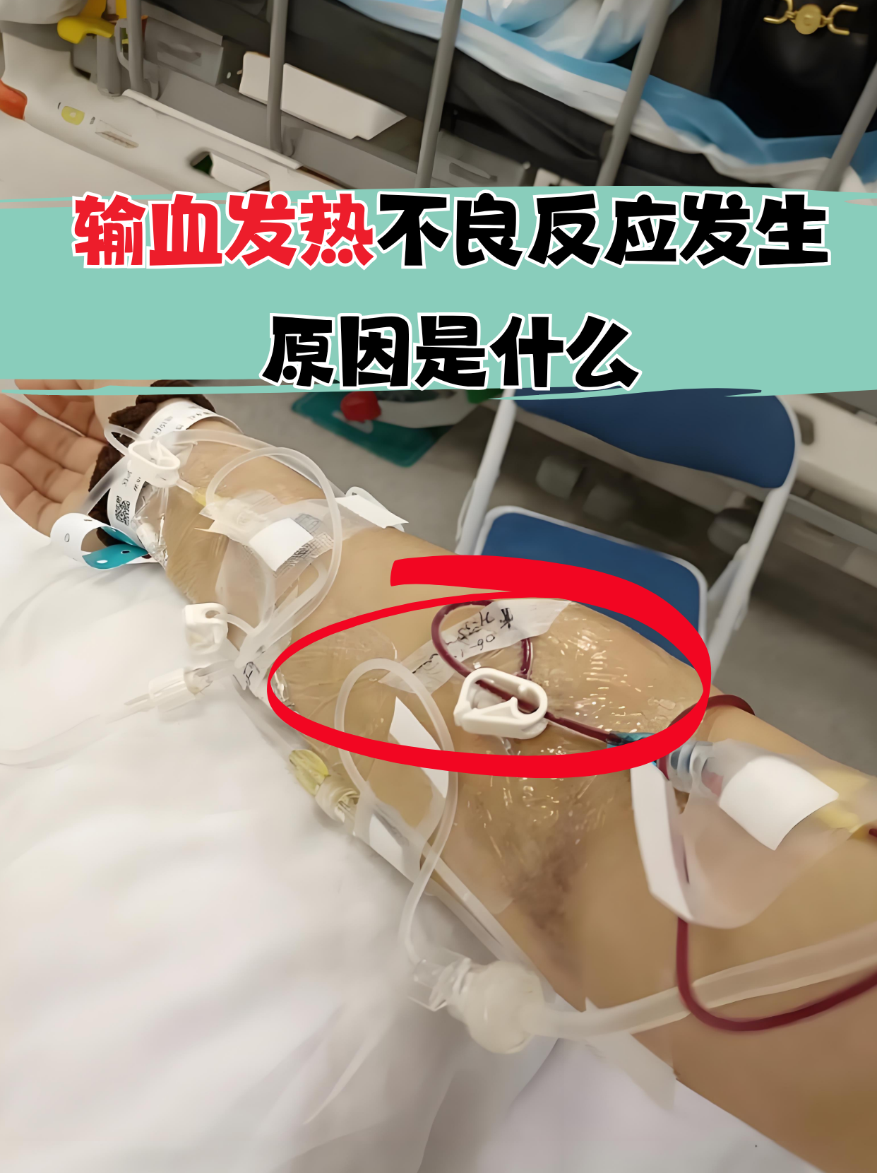 输血发热不良反应发生原因是什么