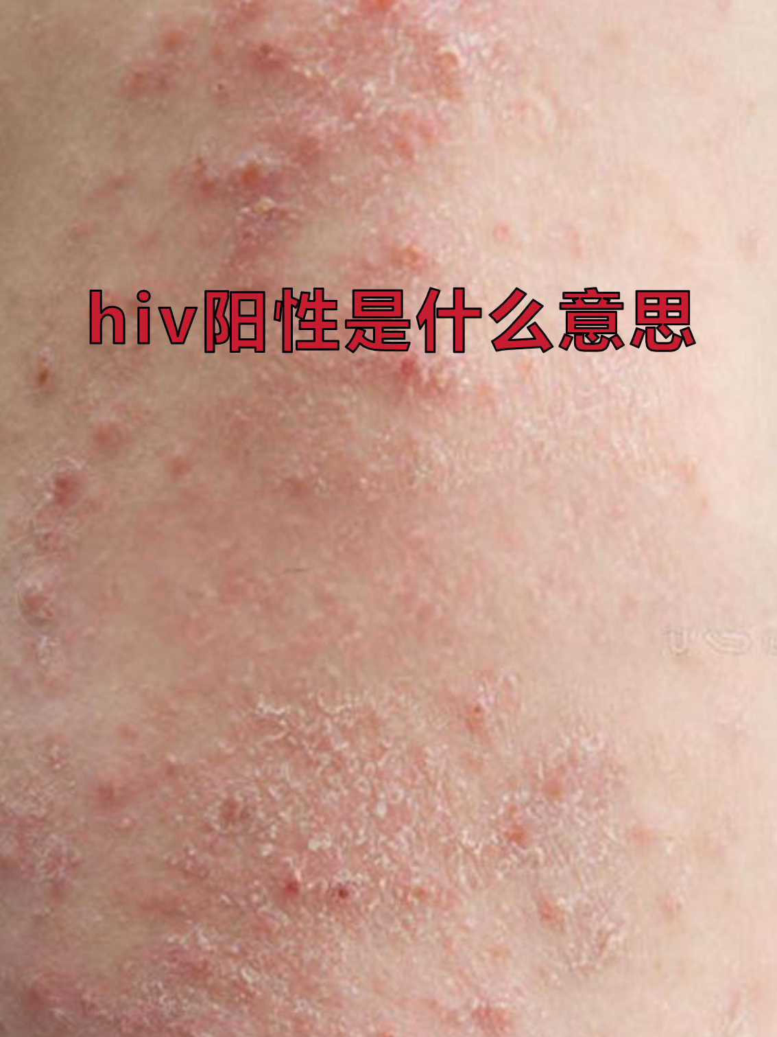  高危52阳性的症状(高危52阳性严重吗)