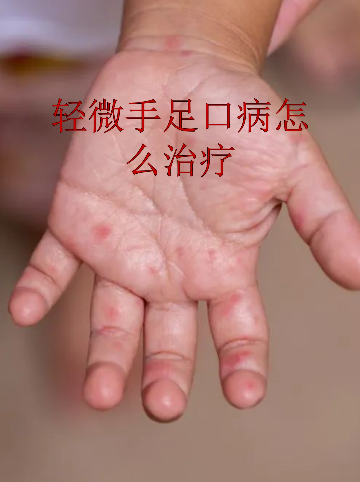 轻微手足口病怎么治疗