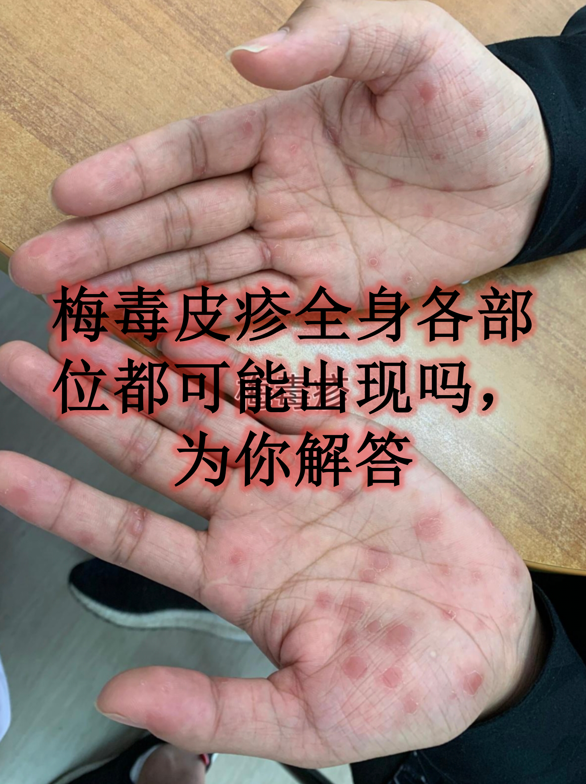 梅毒皮疹全身各部位都可能出现吗,为你解答