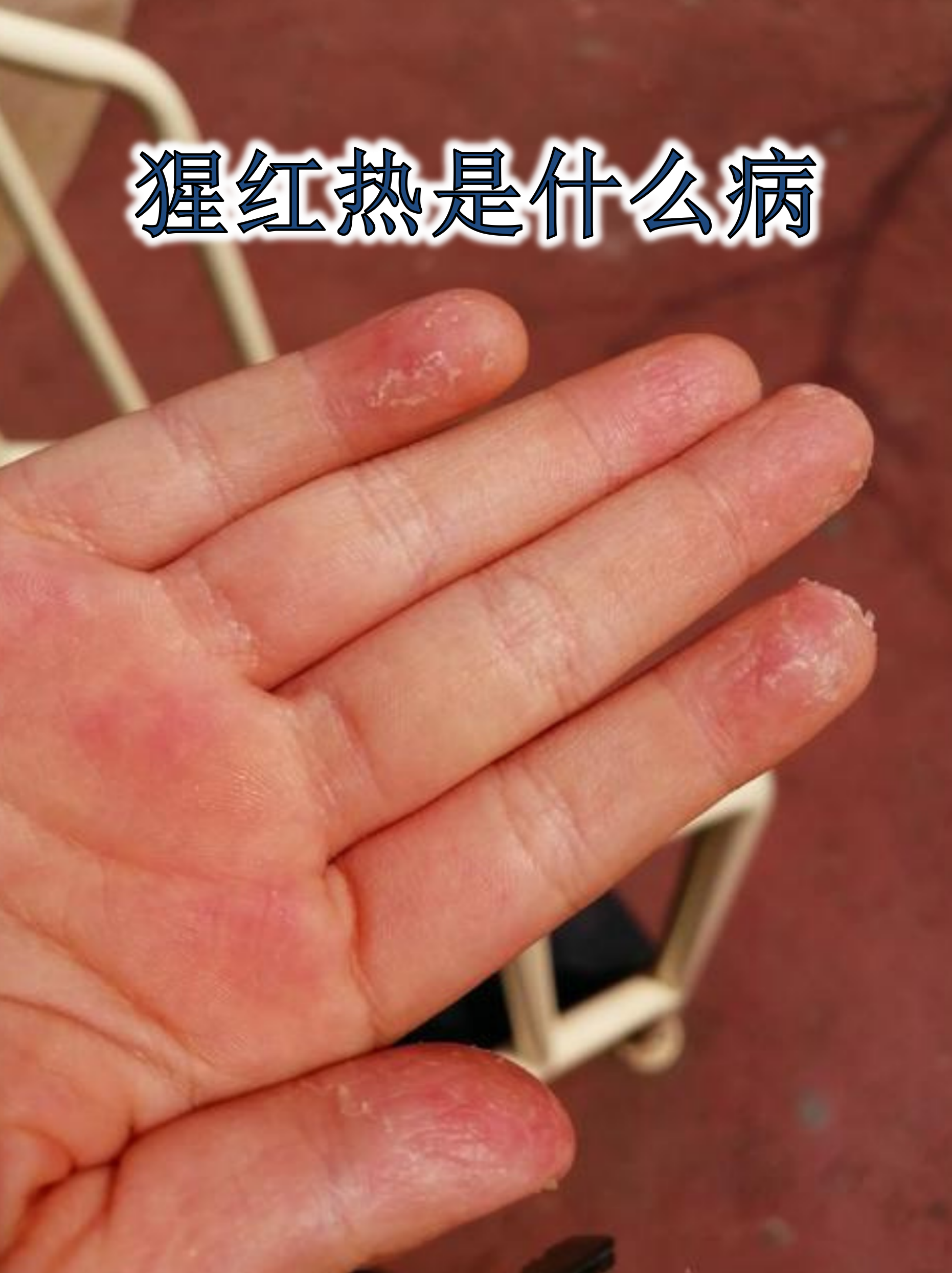 猩红热四大典型症状 发热骤起:体温可