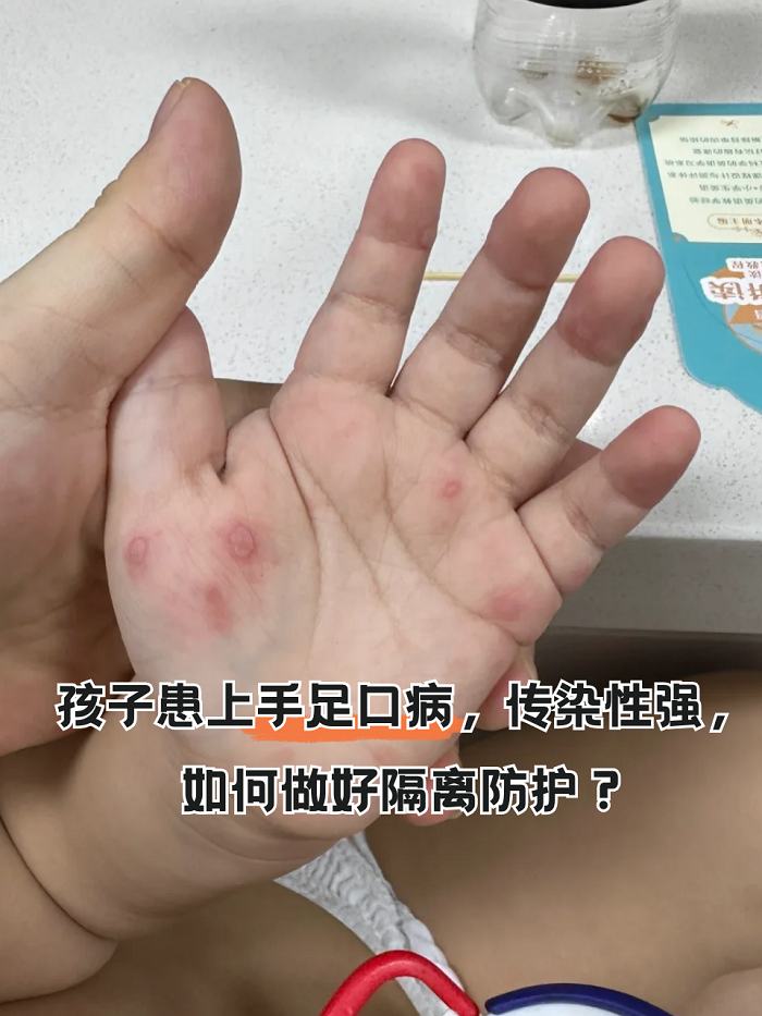 孩子患上手足口病,传染性强,如何做好隔离防护?