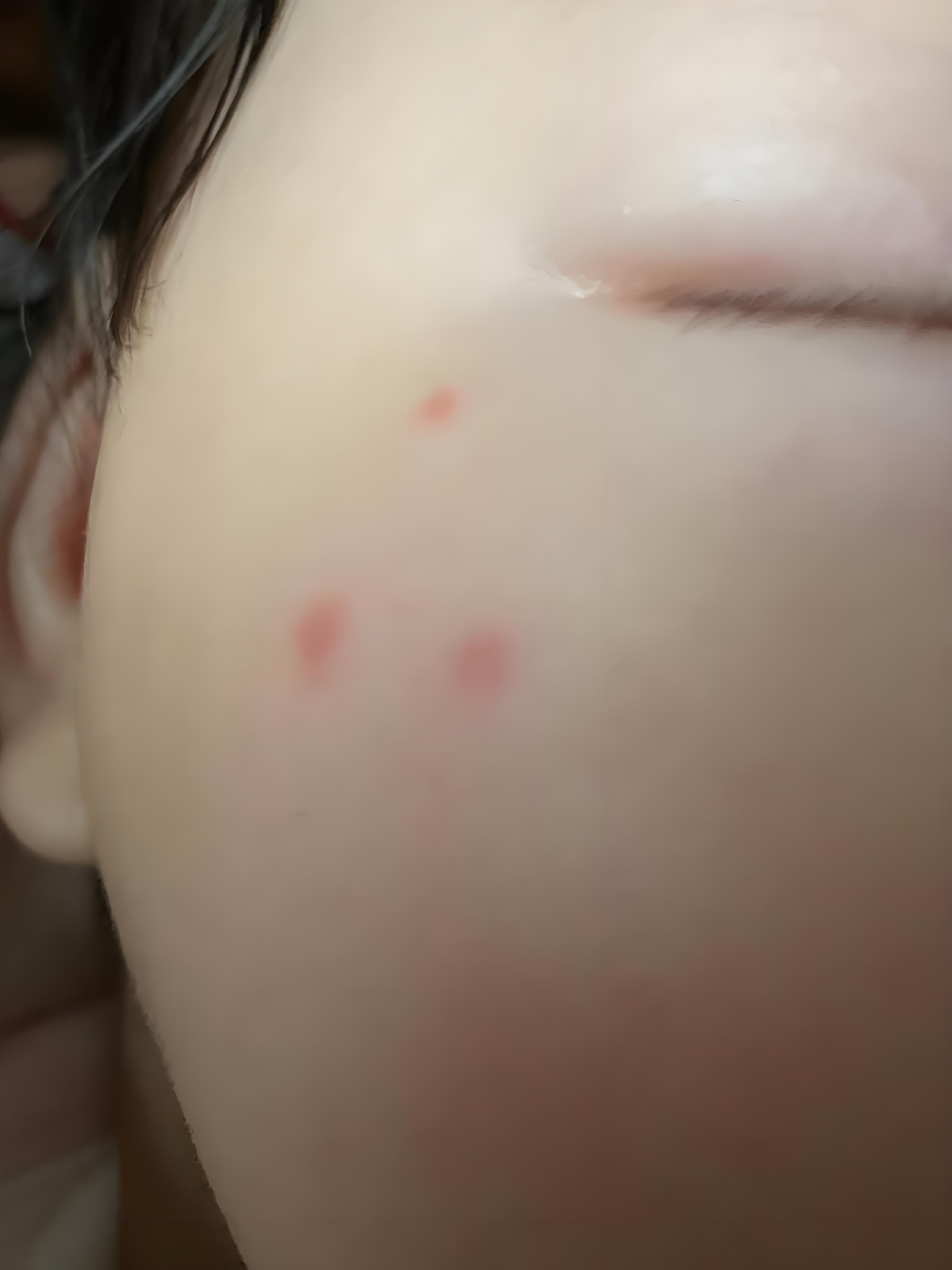 宝宝脸上长小红点?