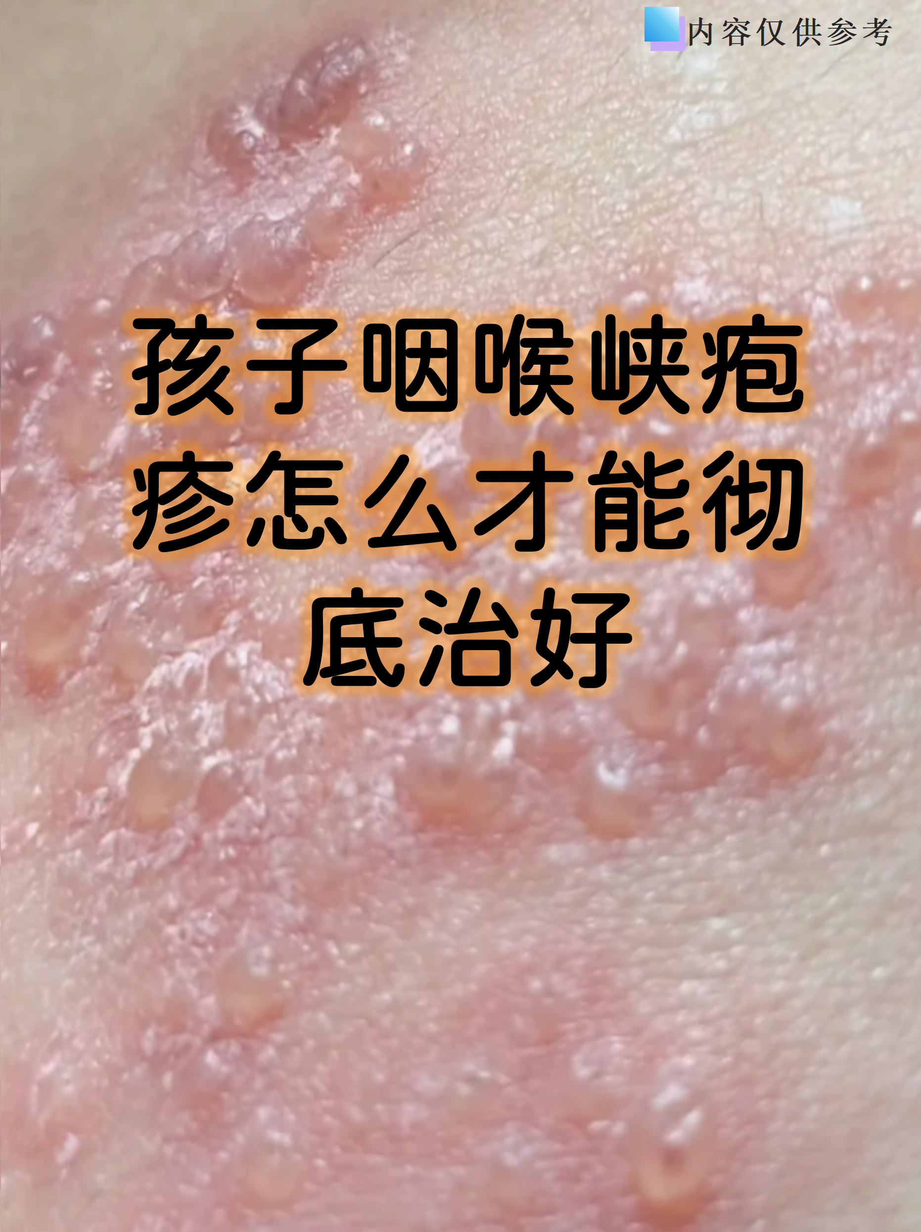 孩子咽喉峡疱疹怎么才能彻底治好