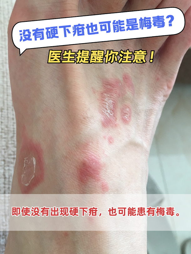 一提到梅毒,很多人就会想到硬下疳,要是没出现硬下疳,是不是就不用