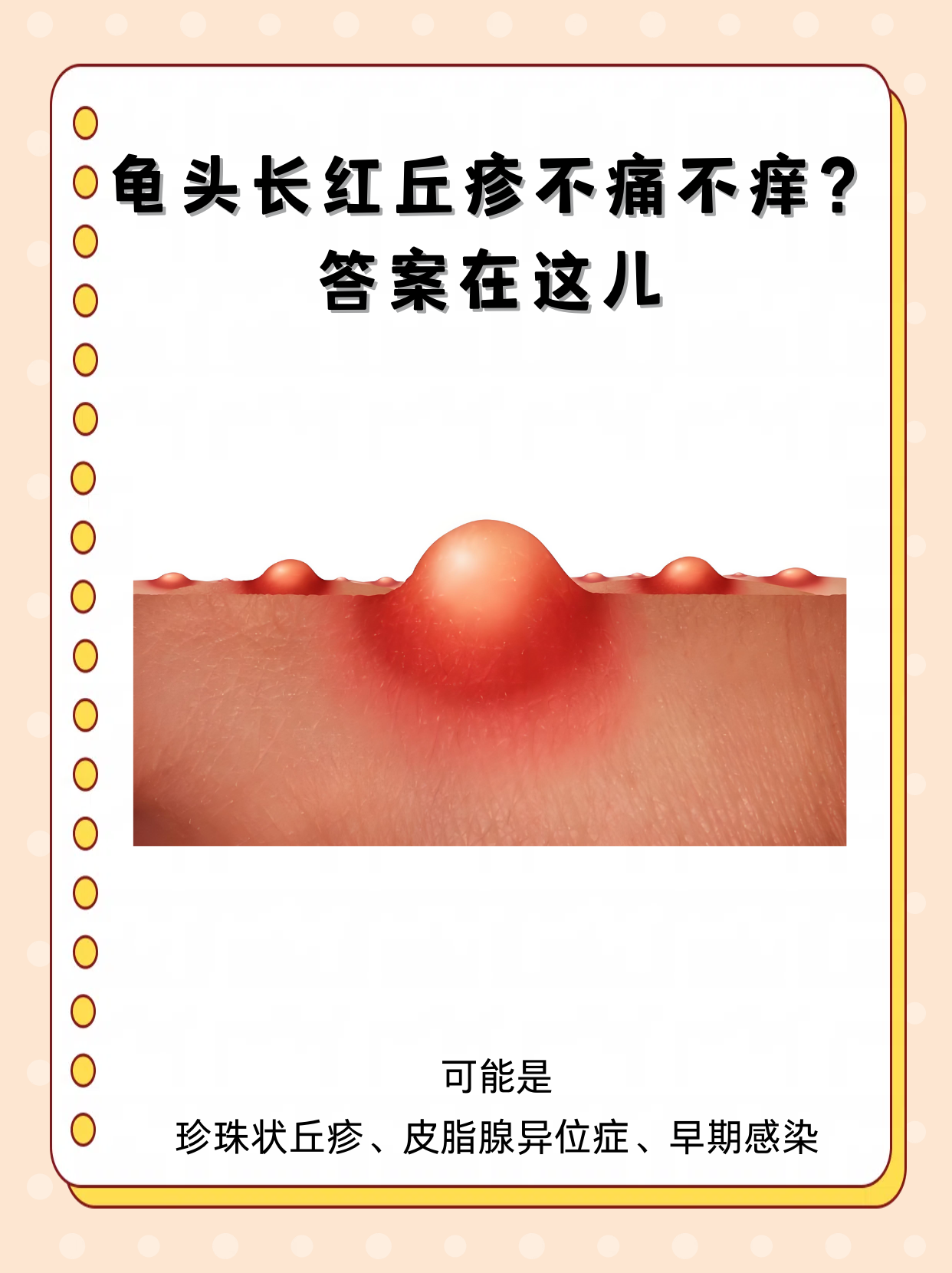 龟头上突然出现不痛不痒的红色丘疹,很多人既困惑又担心