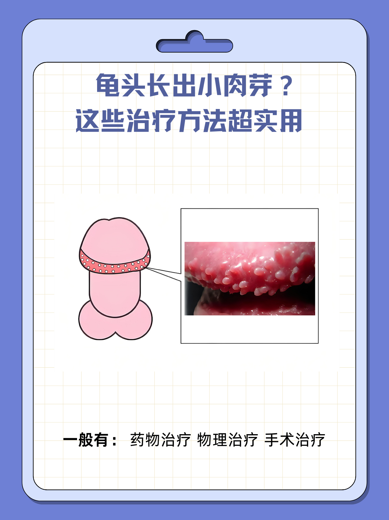 ♂龟头长肉芽需根据具体病因,采取针对性治疗