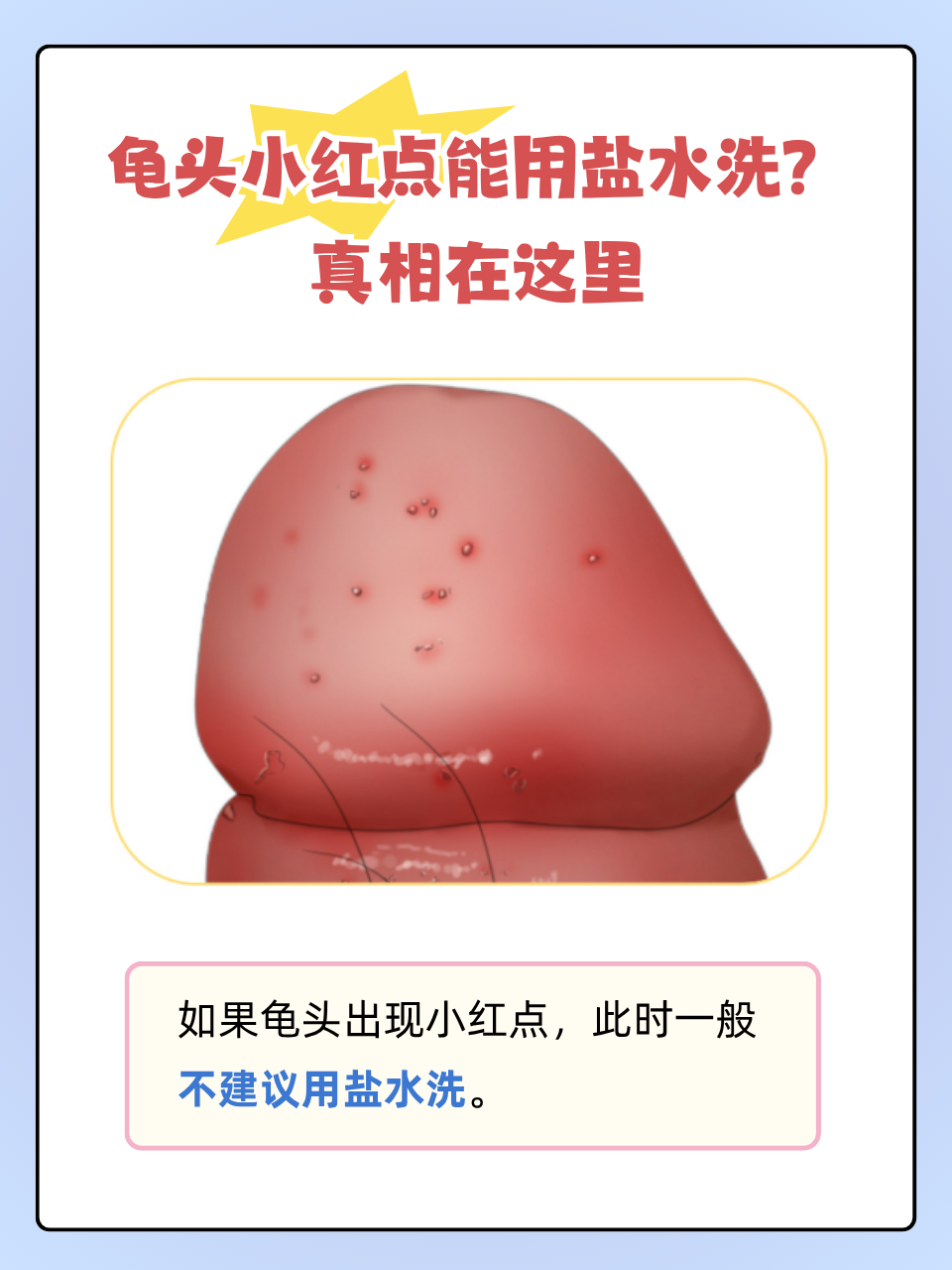 发现龟头出现小红点,不少人想用盐水清洗来解决问题