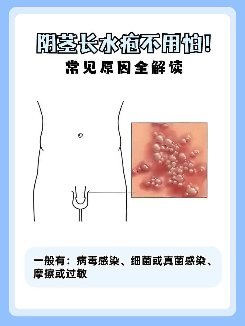 发现阴茎上冒出小水疱,难免让人忧心忡忡