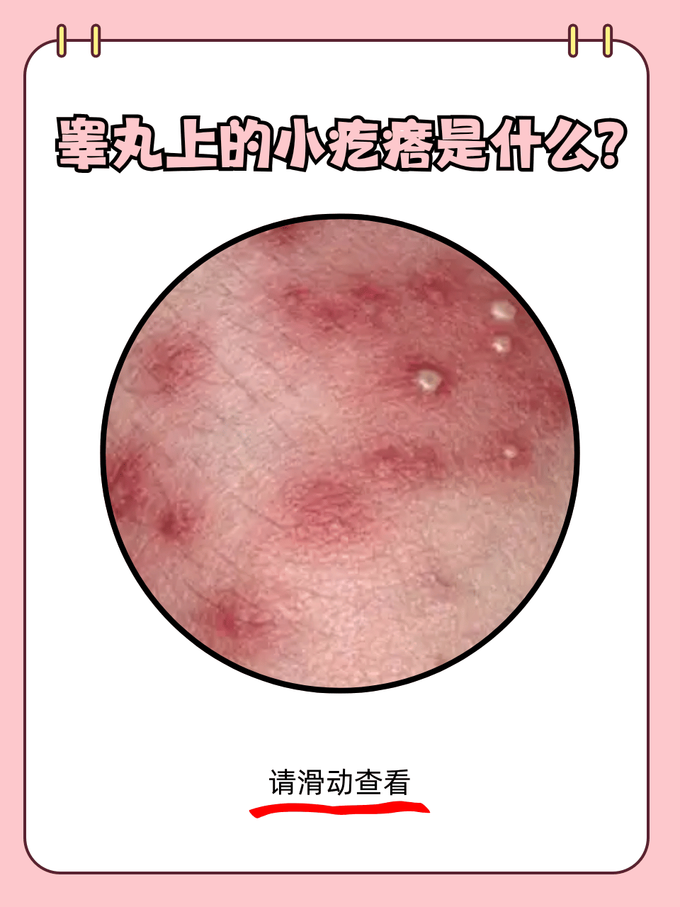 阴囊阴囊上长疙瘩图片阴囊上长了小疙瘩是什么原因生殖表皮上长疙瘩