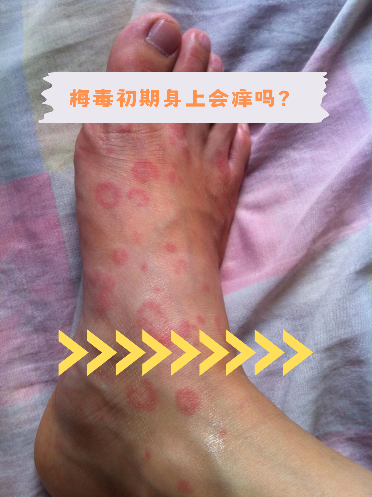 梅毒初期身上会痒吗?