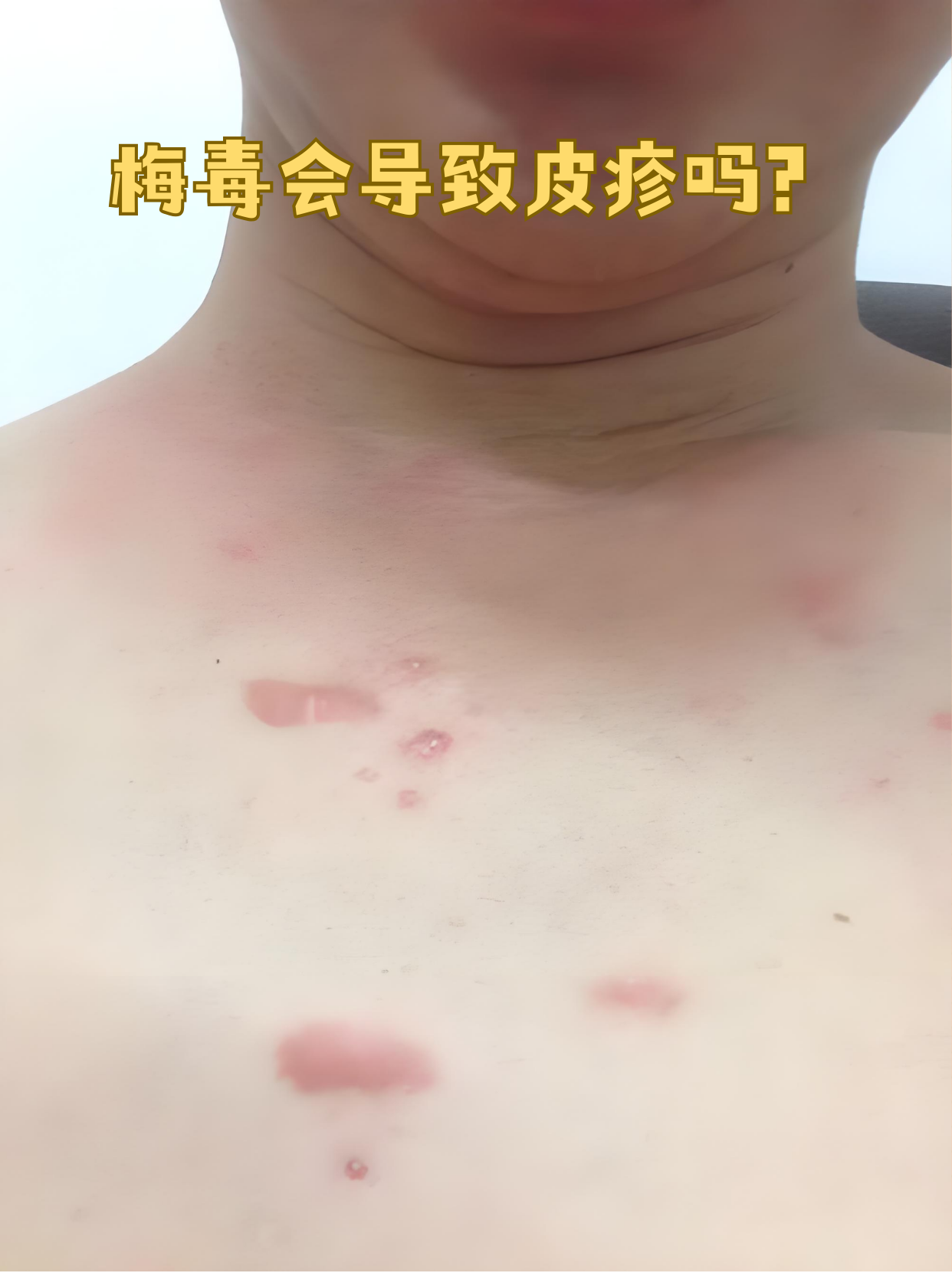 梅毒确实可能引发皮疹,这种皮疹在医学上称为梅毒疹,是二期梅毒牡 
