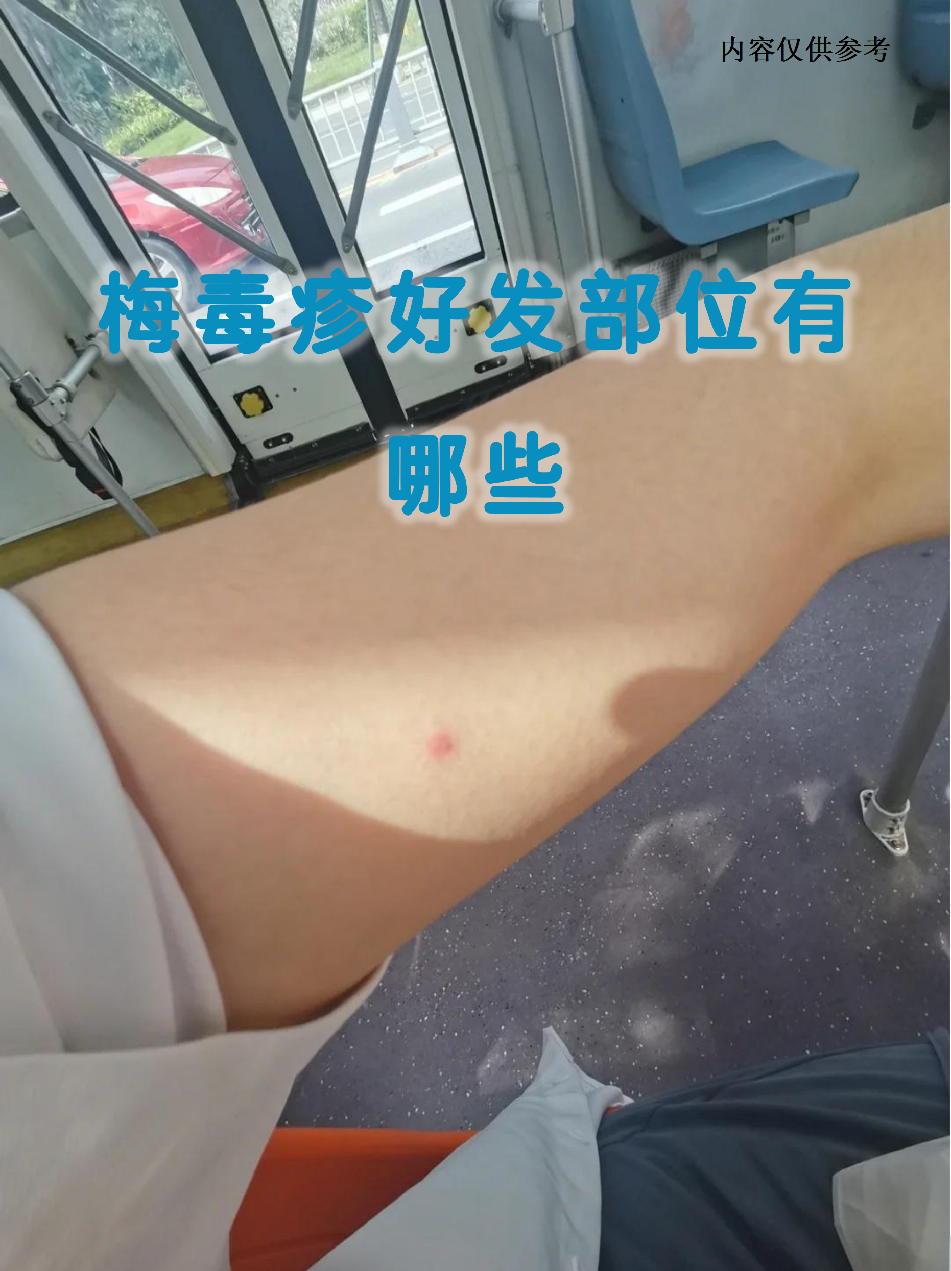 梅毒疹是二期梅毒的典型表现,这种皮肤症状像