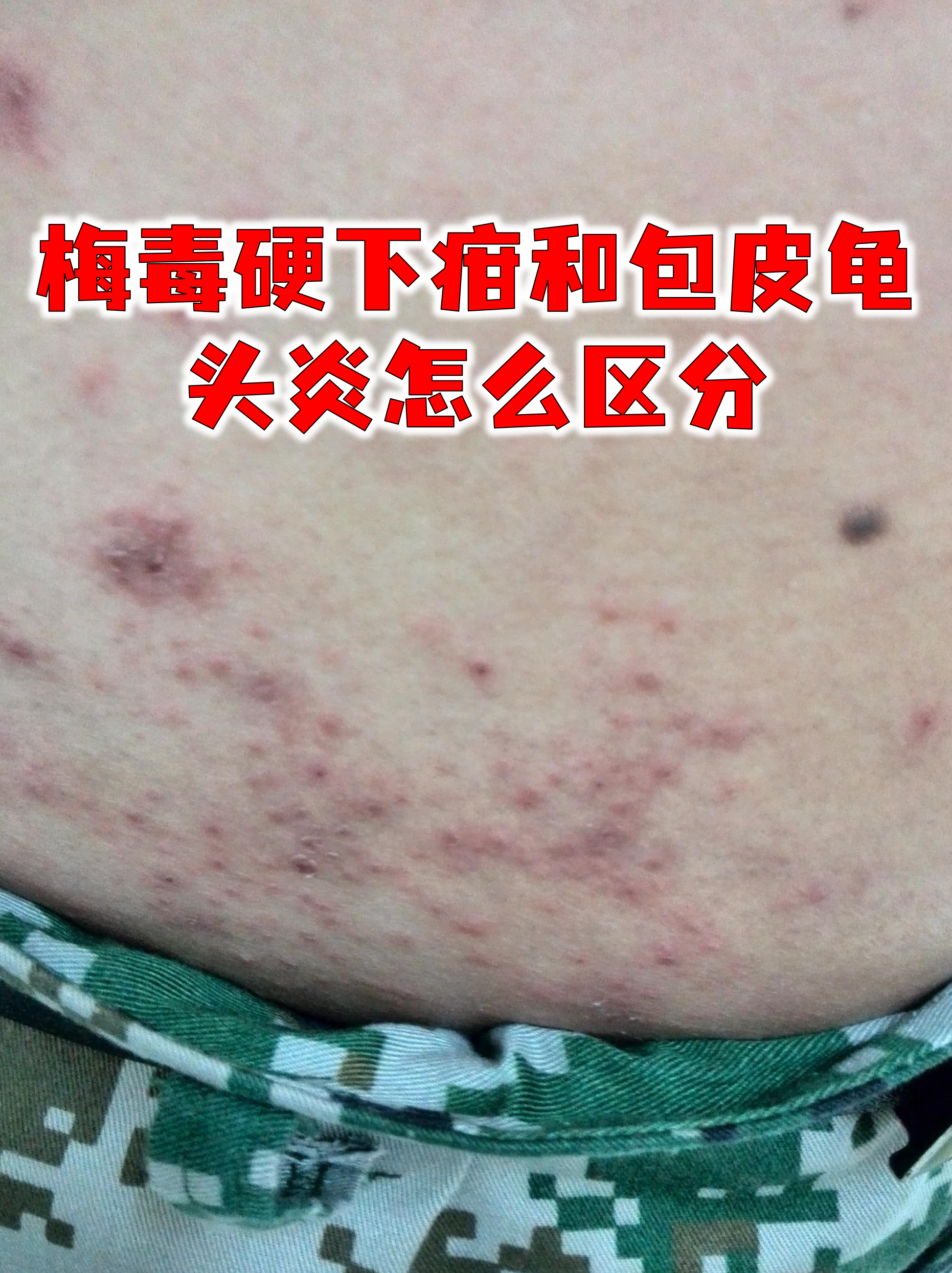 梅毒硬下疳和包皮龟头炎怎么区分