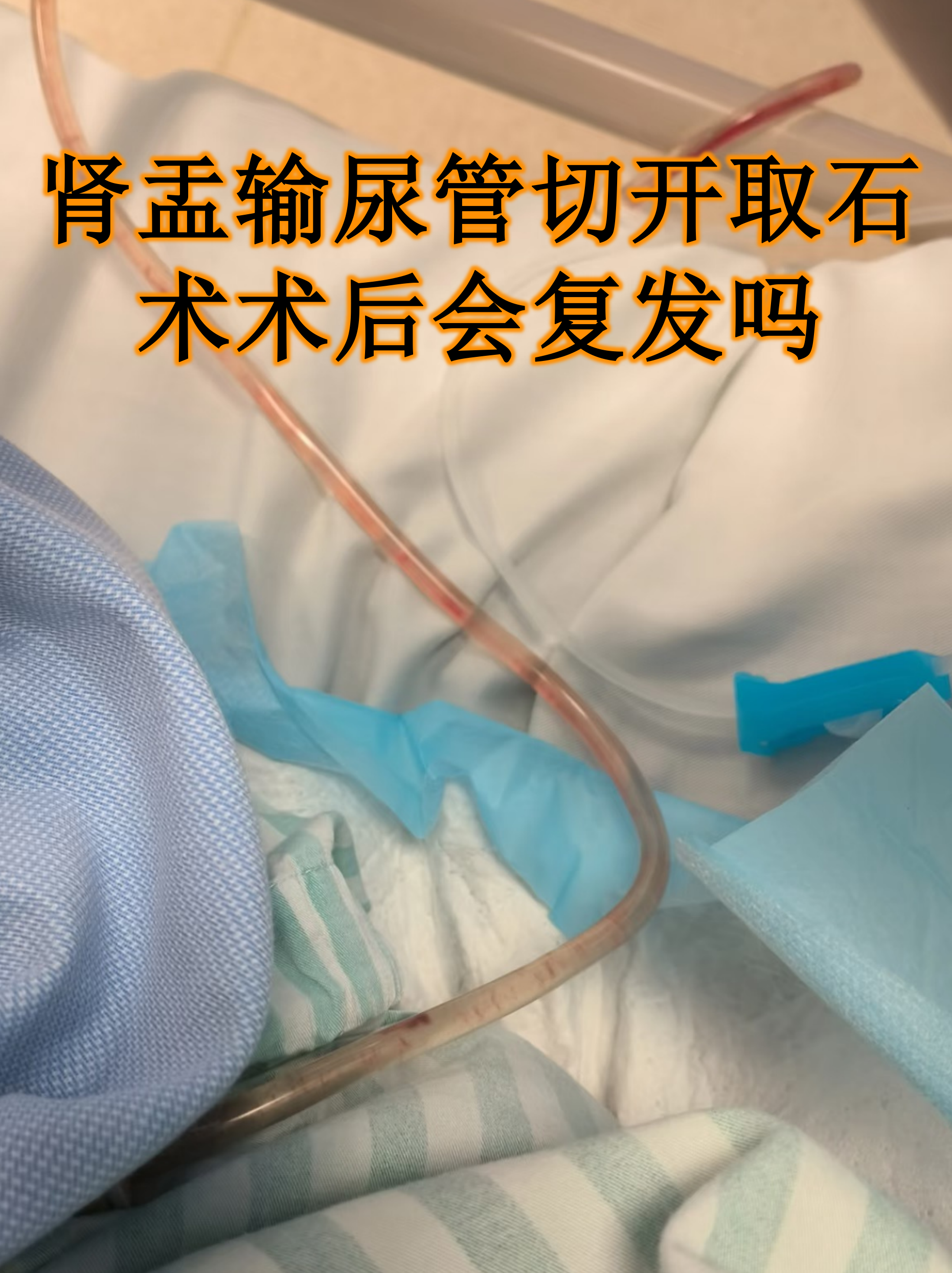 肾盂输尿管切开取石术术后会复发吗