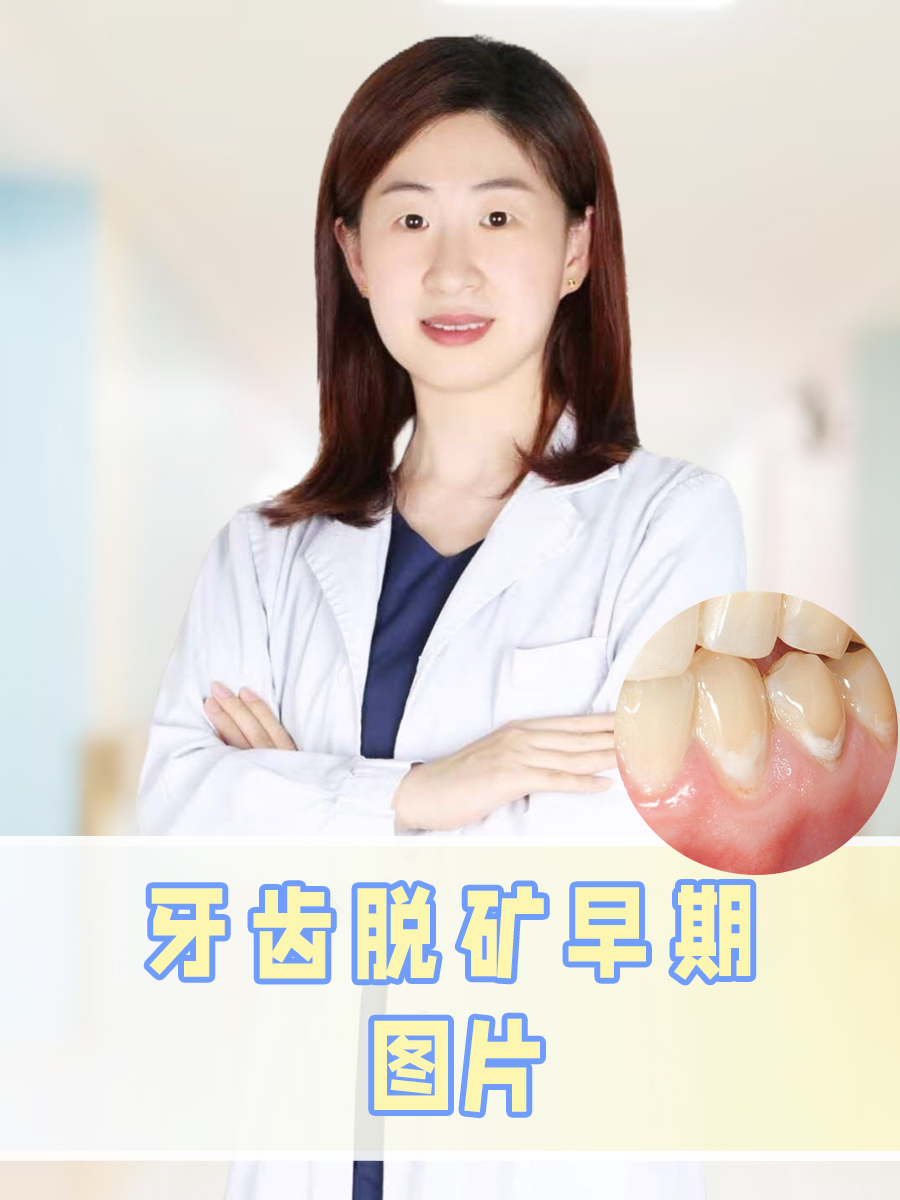 牙齿脱矿早期图片  牙齿健康对于维持整体生活质量具有重要意义,牙齿