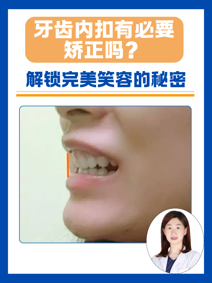 牙齿内扣有必要矫正吗?