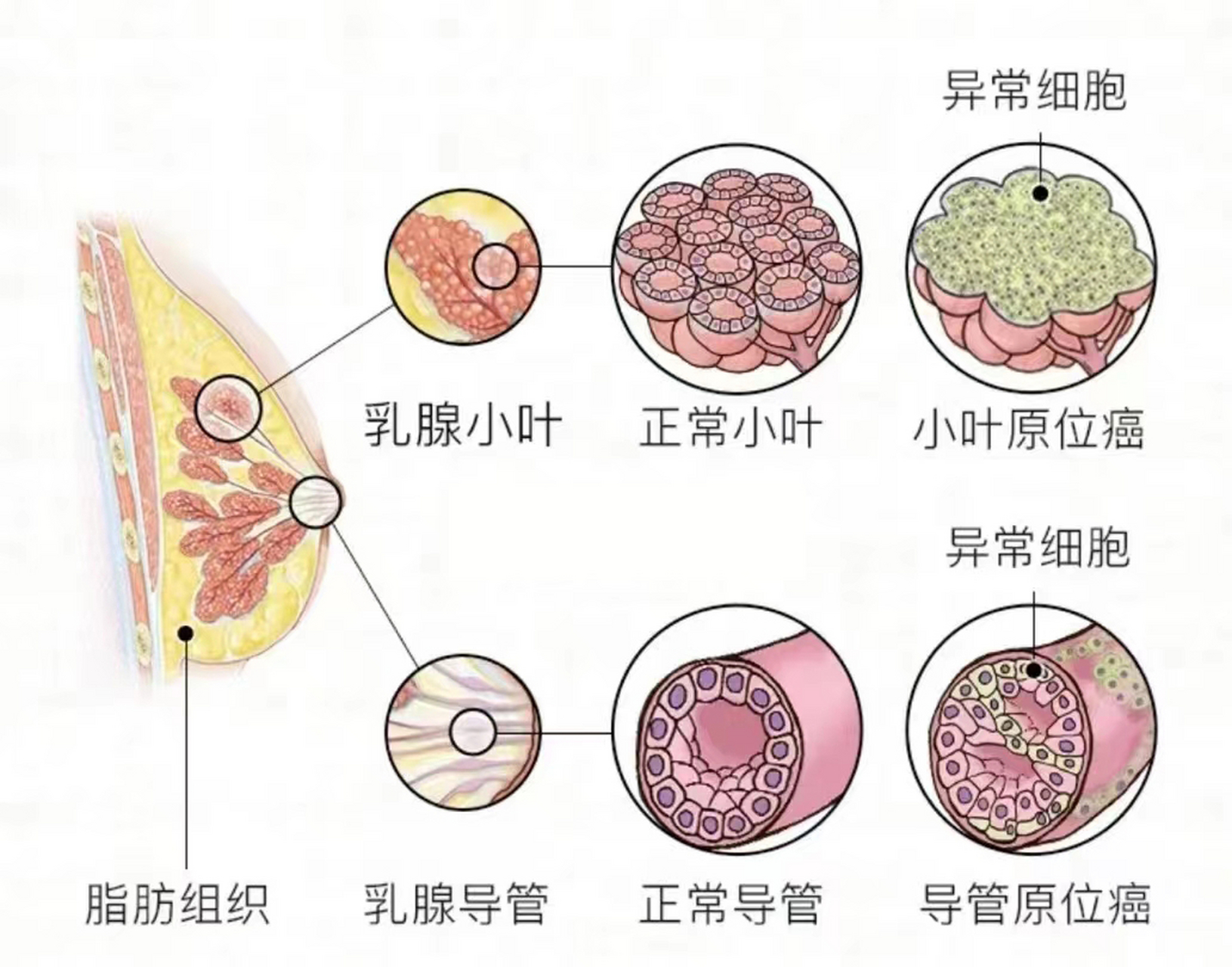 乳腺癌位置图图片