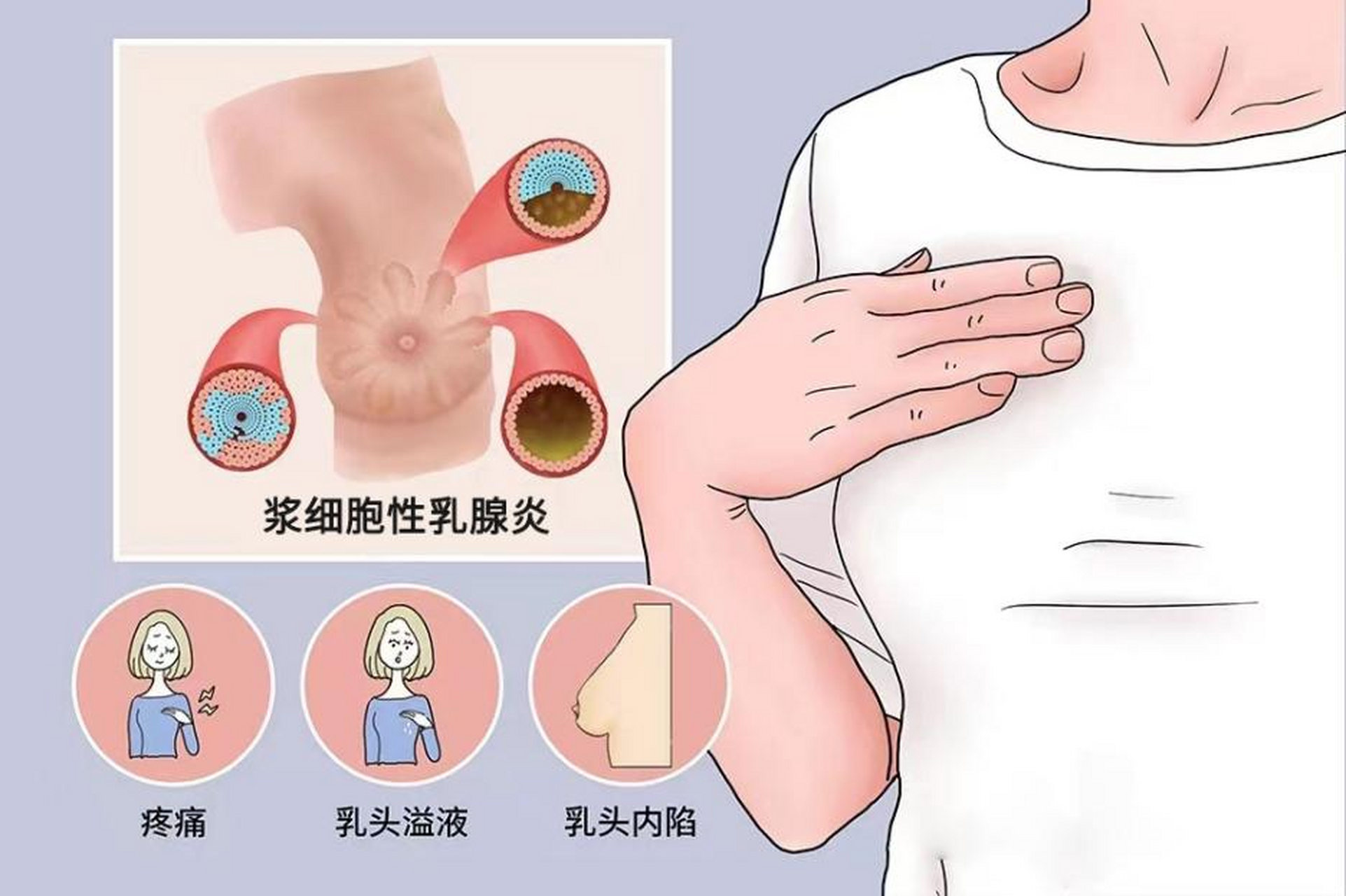 浆细胞性乳腺炎:非哺乳期女性的隐形威胁 在女性健康的版图上,有一种