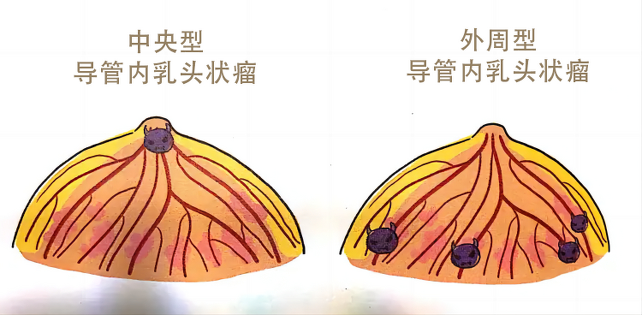 在女性乳腺健康的旅途中,导管内乳头状瘤或许是一个不那么起眼,但绝