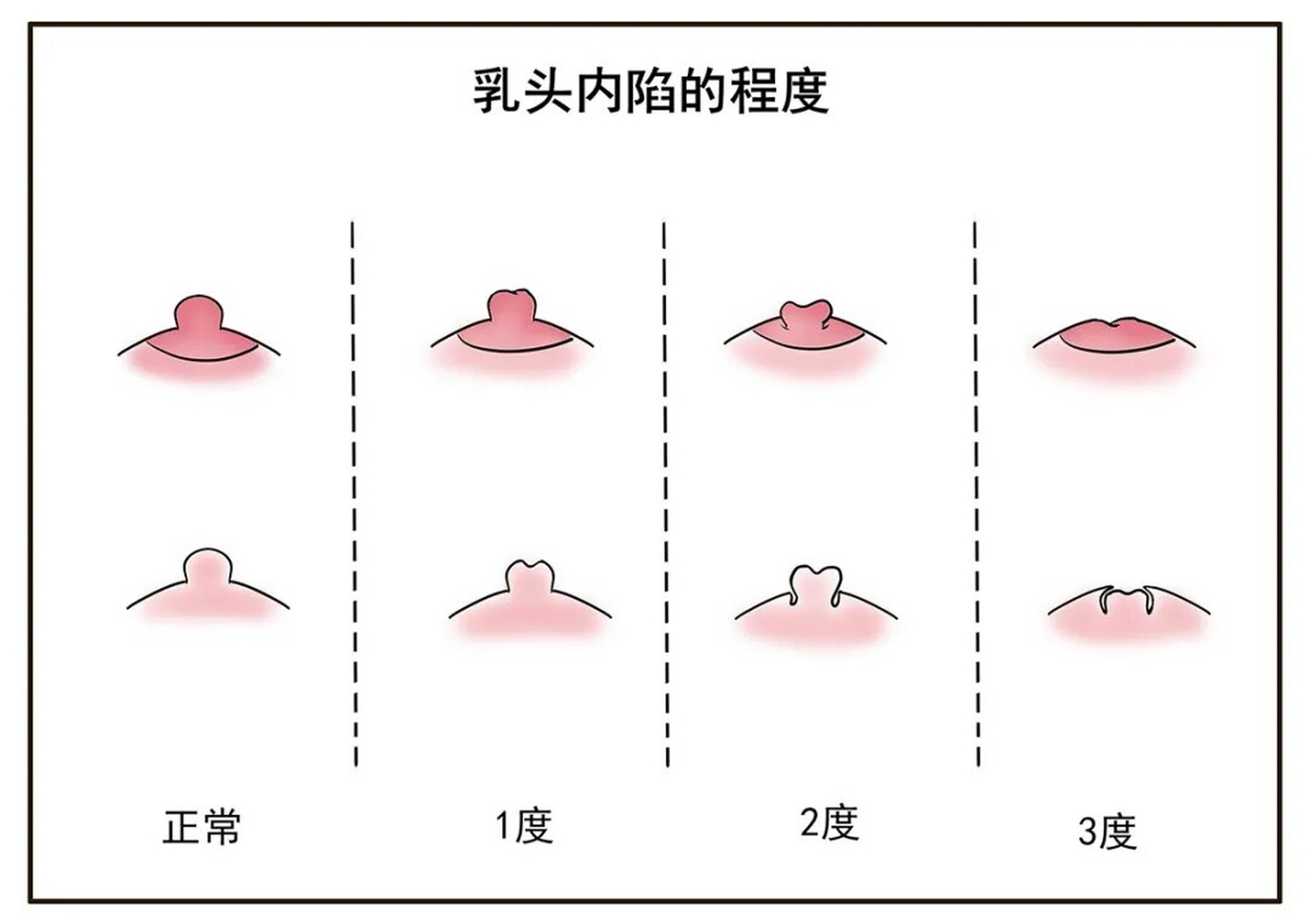 乳头内陷揭秘:从成因到对策,守护乳房之美  乳房,作为女性身体的重要