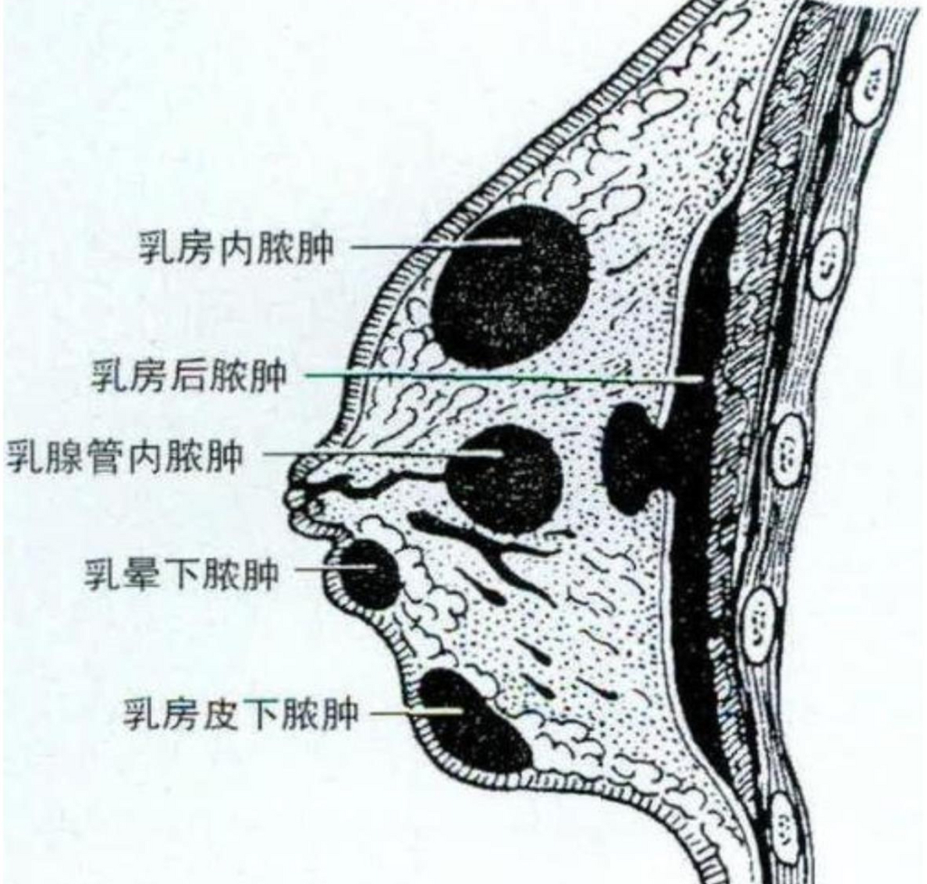 乳腺癌症初期脓包图片图片