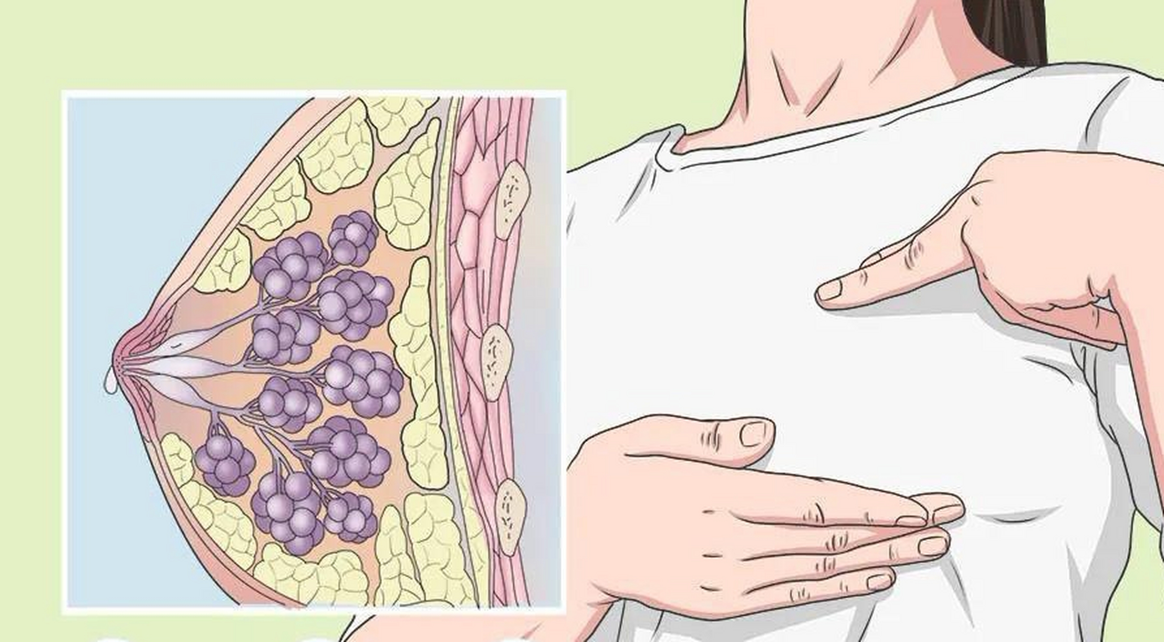 基本病因  乳腺导管扩张症的病因尚不明确,可能与乳腺导管排泄障碍