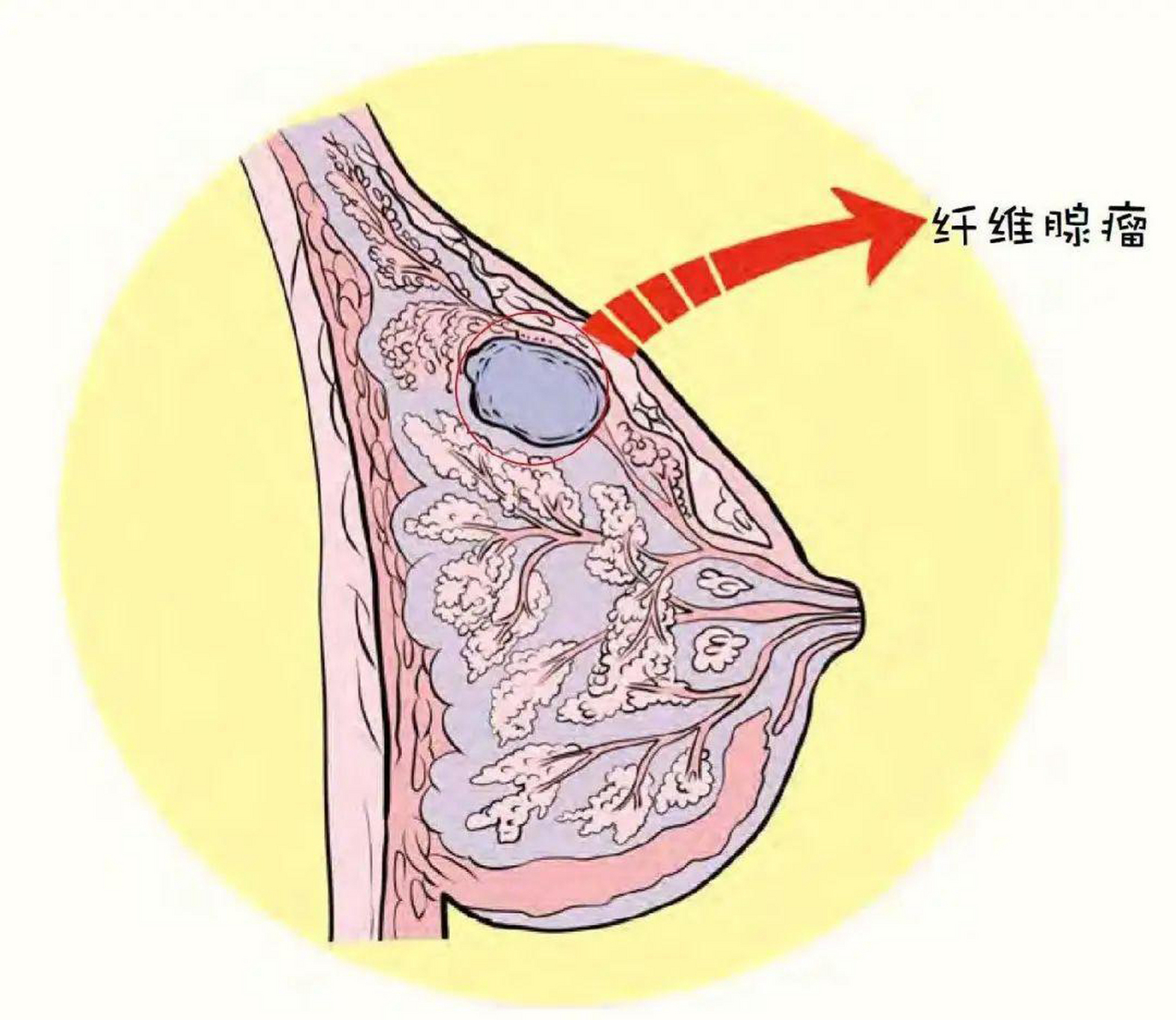 乳腺纤维瘤的样子图片图片