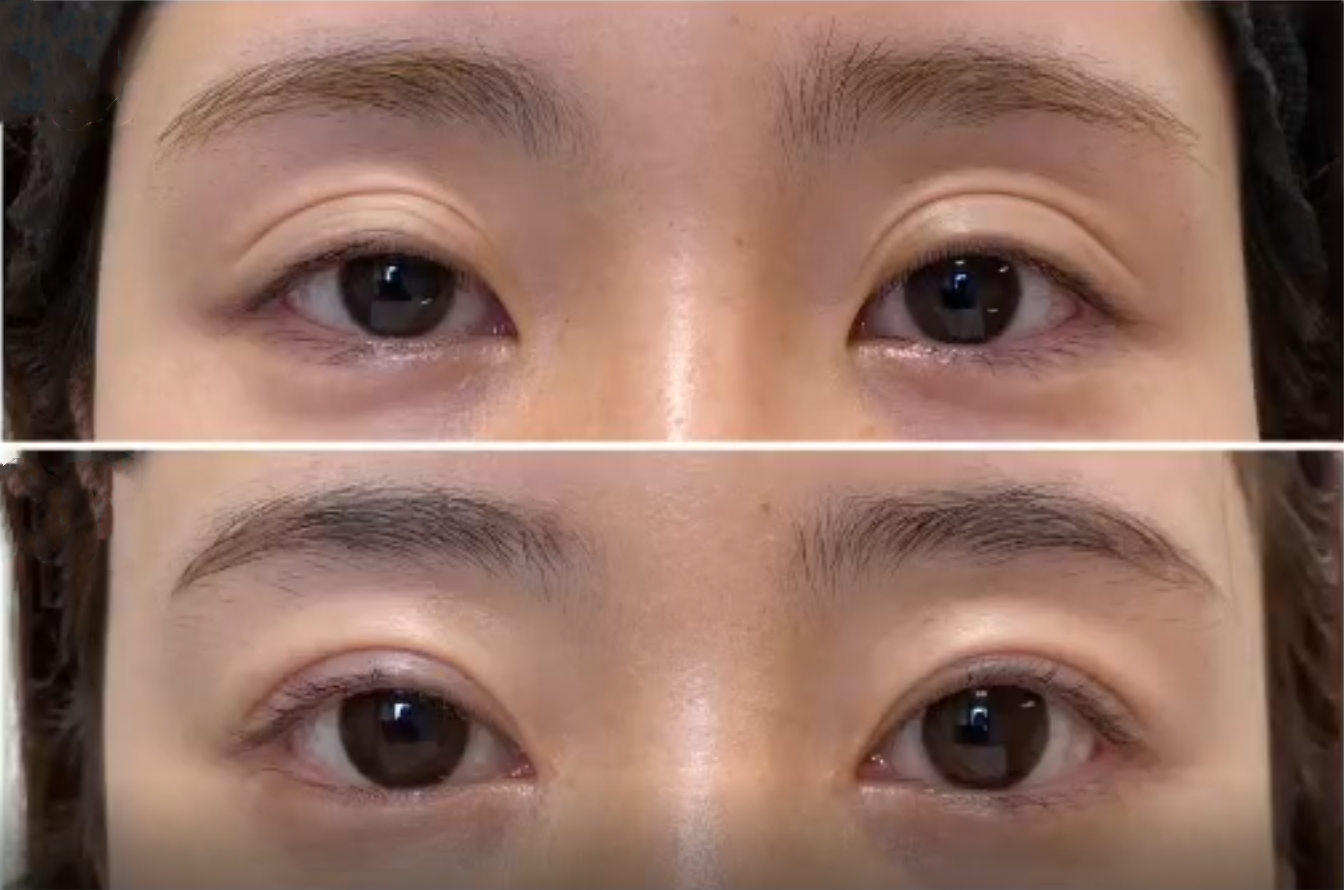 但方法得对!两只眼睛大小眼,怎么做双眼皮能做到一样吗?答案是:能!