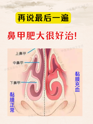 鼻甲肥大危害不少