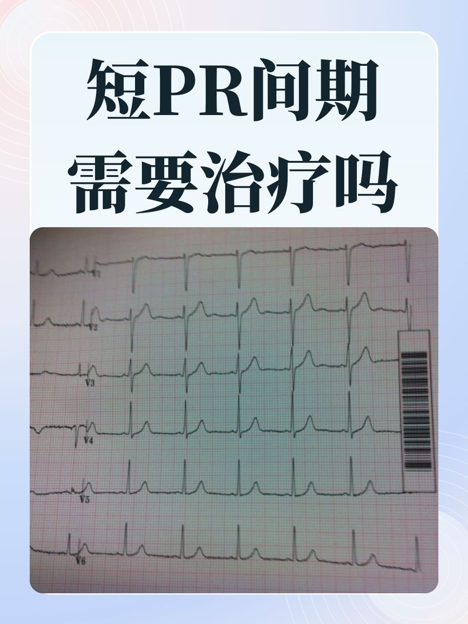 在心电图检查中,pr间期是一个重要的参数,它反映