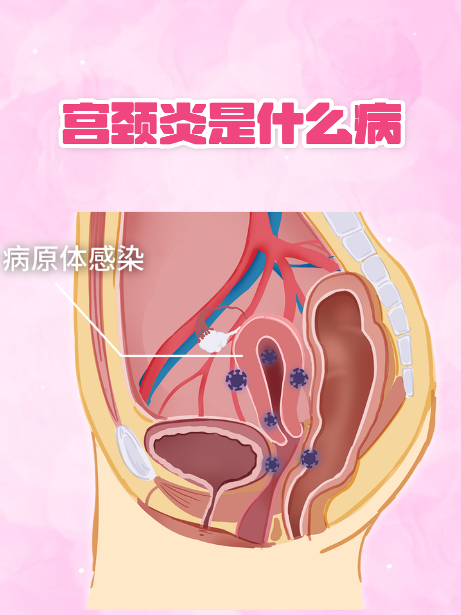 我经常遇到各种妇科疾病的咨询和诊疗,其中宫颈炎是较为