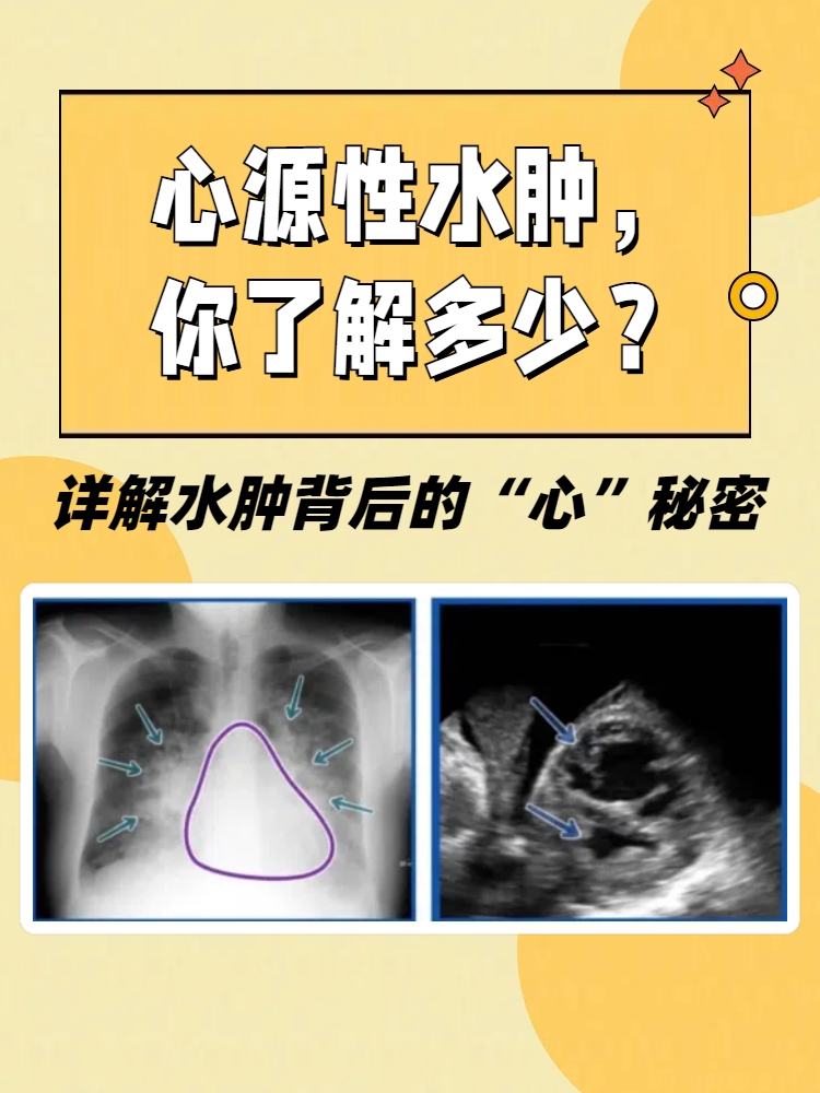 心衰会引起水肿吗怎么治疗百科在线 心衰会引起水肿吗怎么治疗百科在线