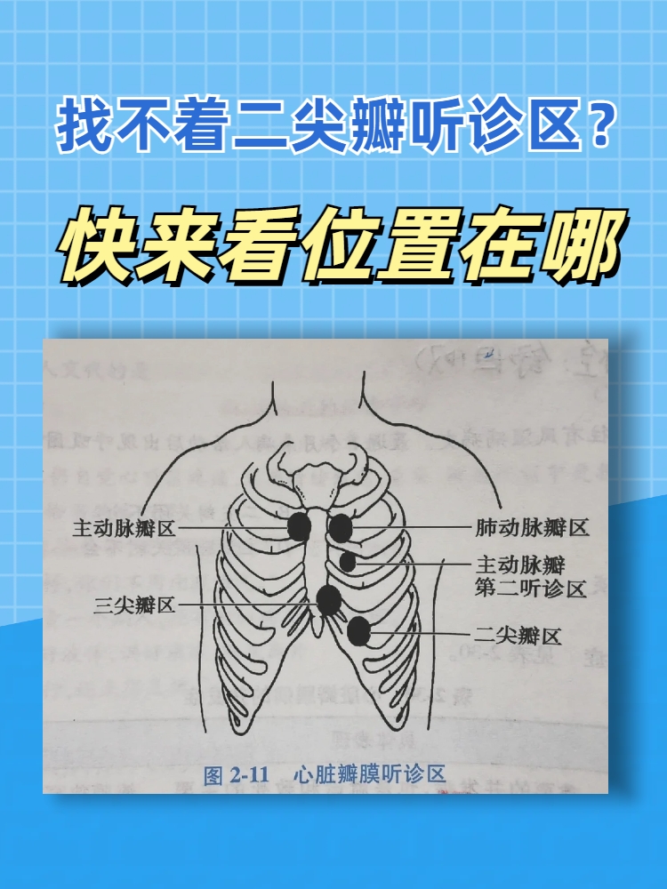 为了更清晰地听到二尖瓣开闭时产生的声音,而特心脏听诊部位5个示意图