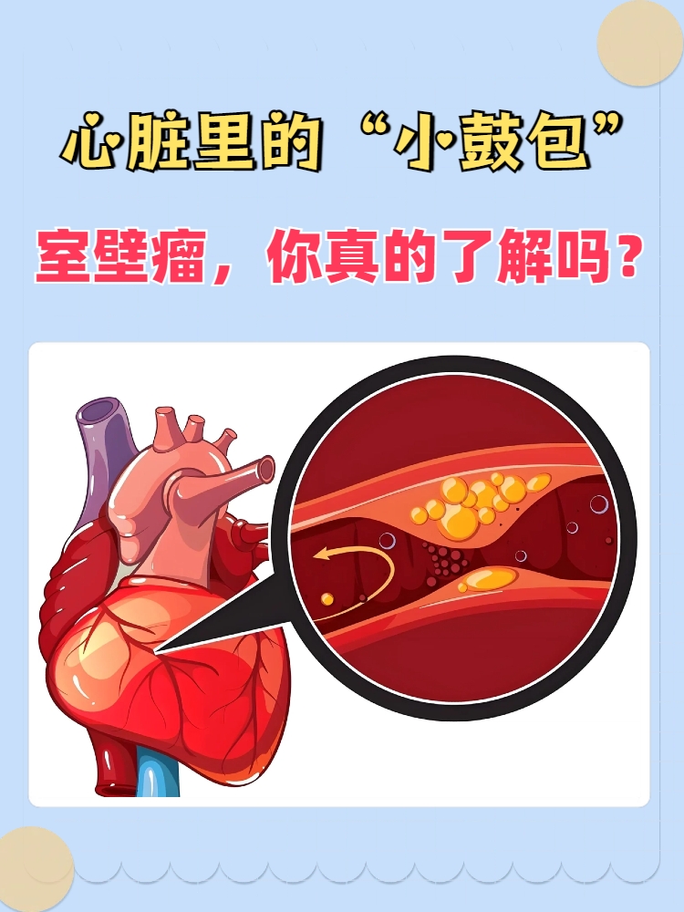 室壁瘤像是心脏肌肉上鼓起的一个小包,它通常发生在心肌梗死后,部分
