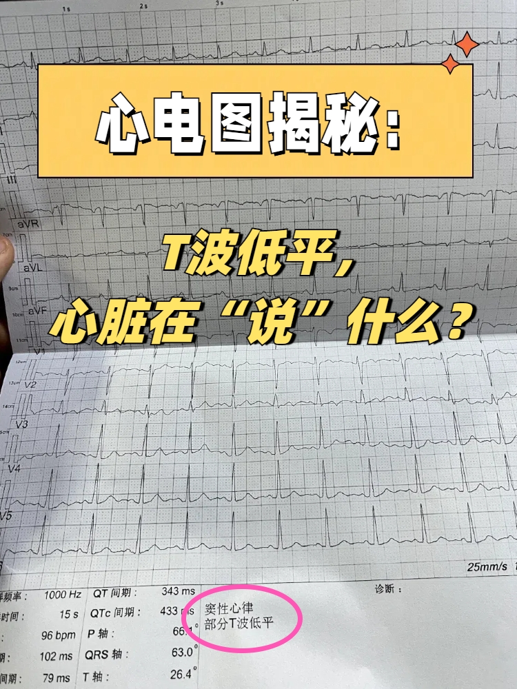 心电图揭秘:t波低平,心脏在"说"什么?