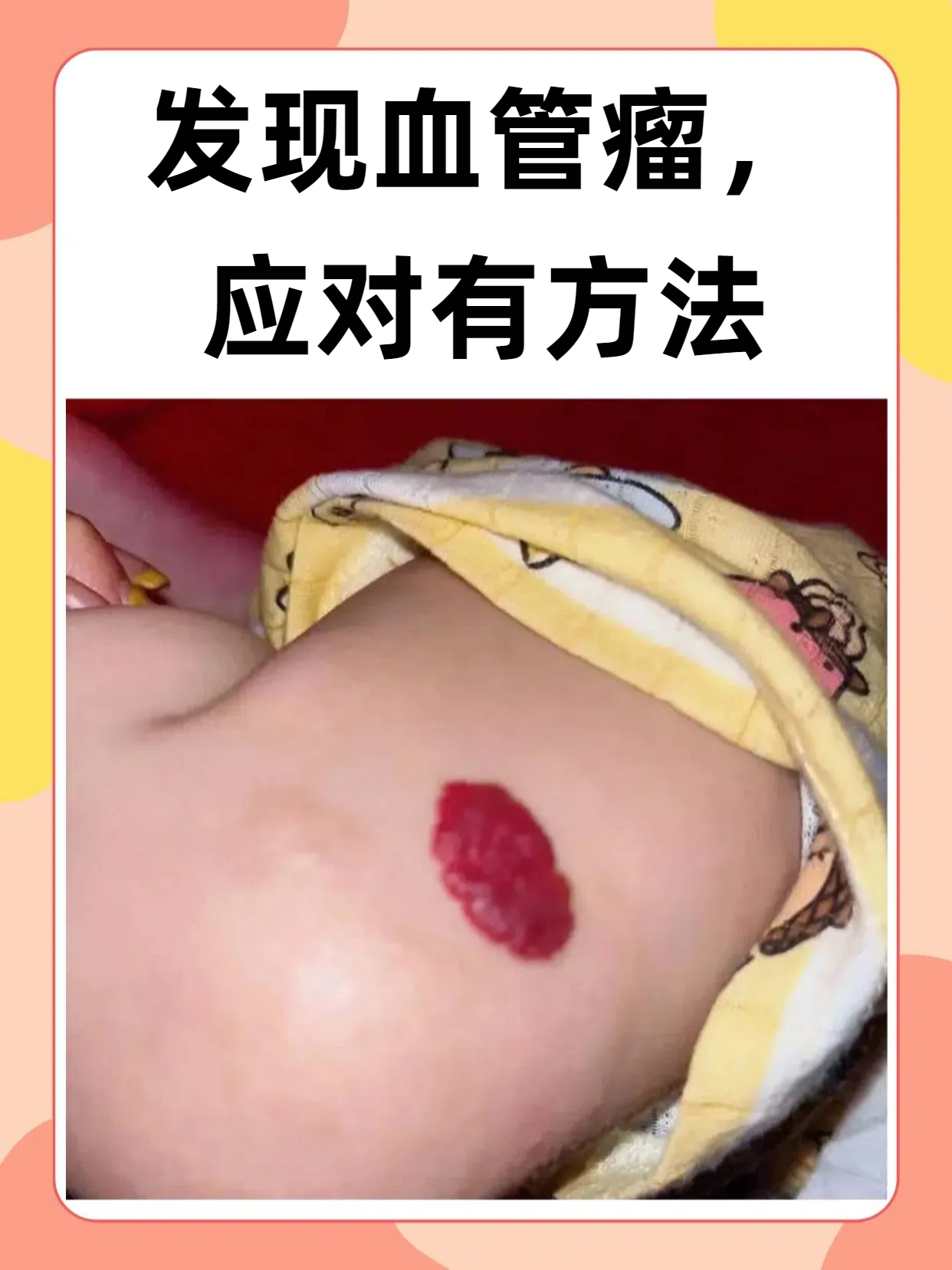 血管瘤是常见于皮肤和软组织内的先天性良性肿瘤或血管畸形,多见于