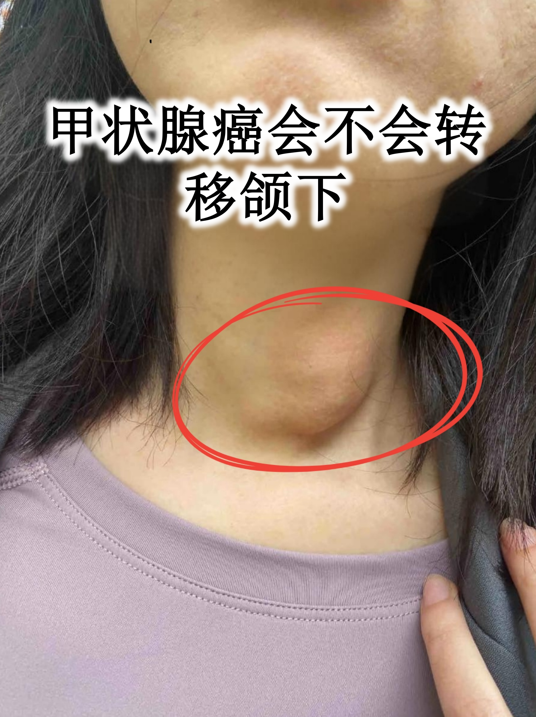 颌下淋巴结是头颈部常见转移部位之一,尤其当肿瘤原发灶靠近甲状腺上