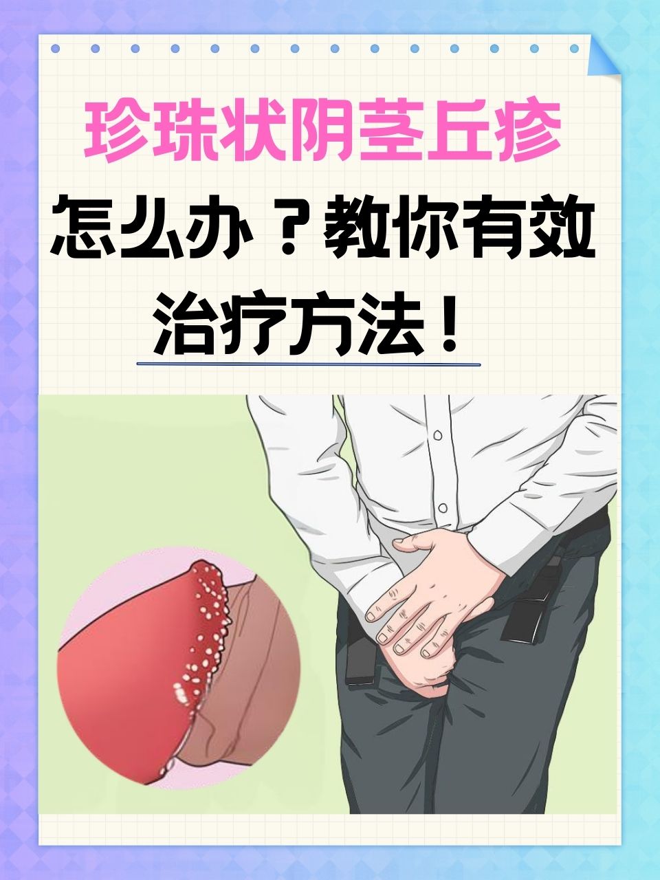珍珠状阴茎丘疹,这一名词或许对很多人来说并不陌生,但真正了解它的