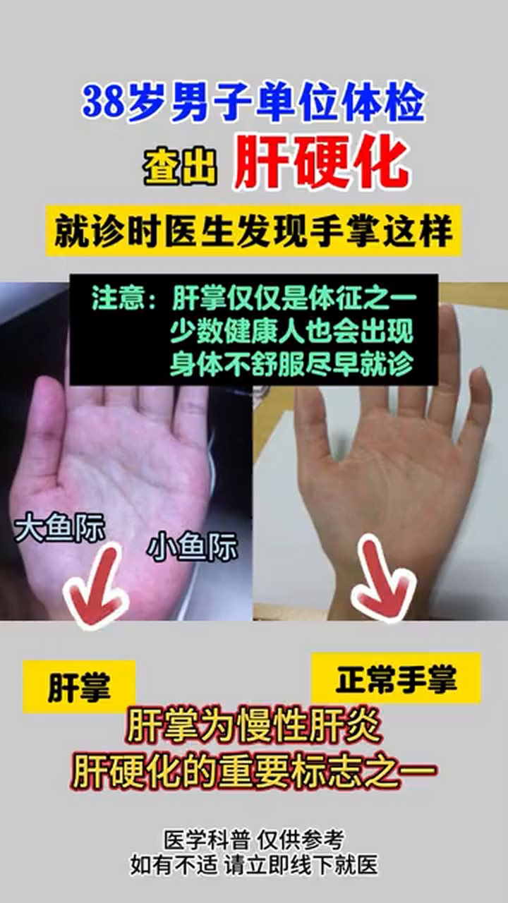 身体不舒服尽早就诊.肝掌为慢性肝炎肝硬化的重要标志之一.